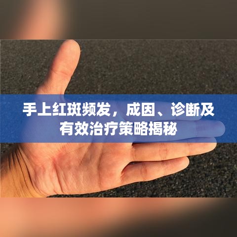 手上紅斑頻發(fā)，成因、診斷及有效治療策略揭秘
