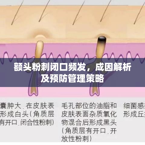 額頭粉刺閉口頻發(fā)，成因解析及預(yù)防管理策略